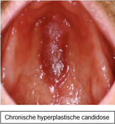 Chron_hyperplastische-candidose.png