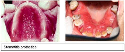 Stomatitis-prothetica.png